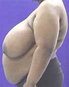 μείωση μαστού παχυσαρκία